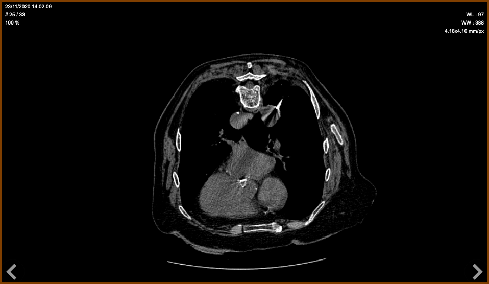 Biopsie sous scanner