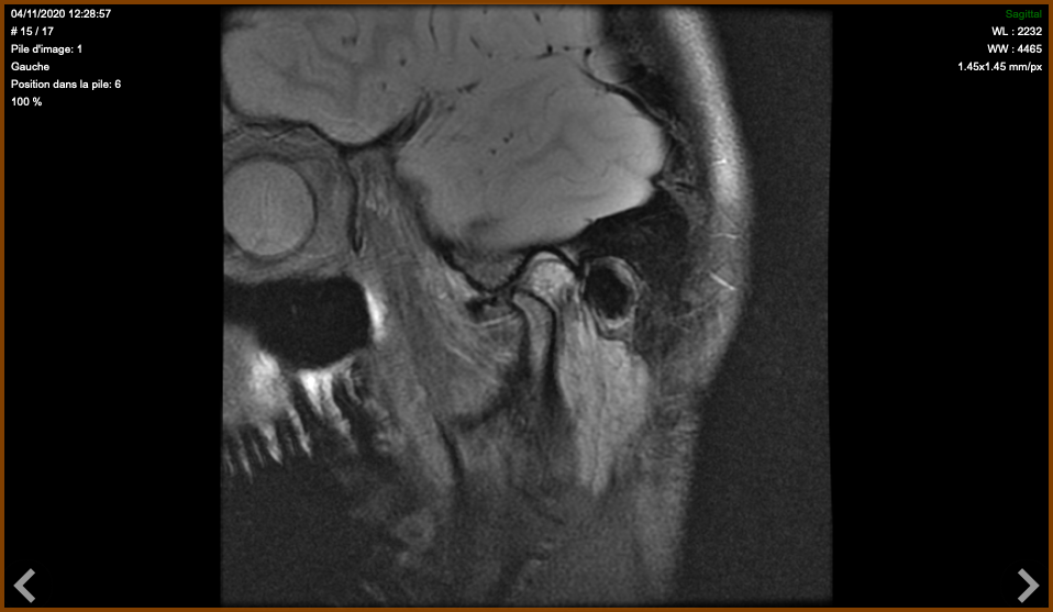 Articulations temporo-mandibulaires