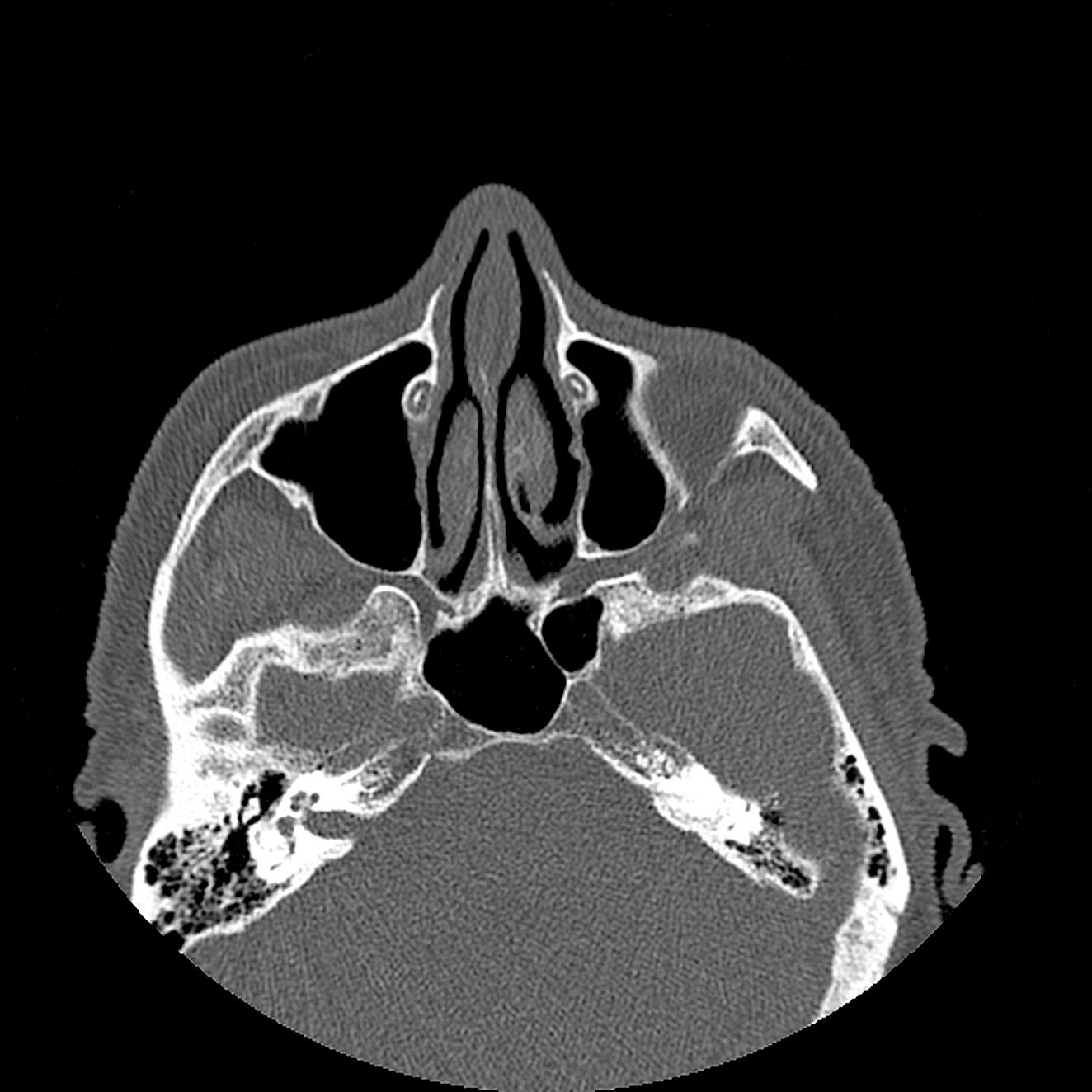 Dacryoscanner