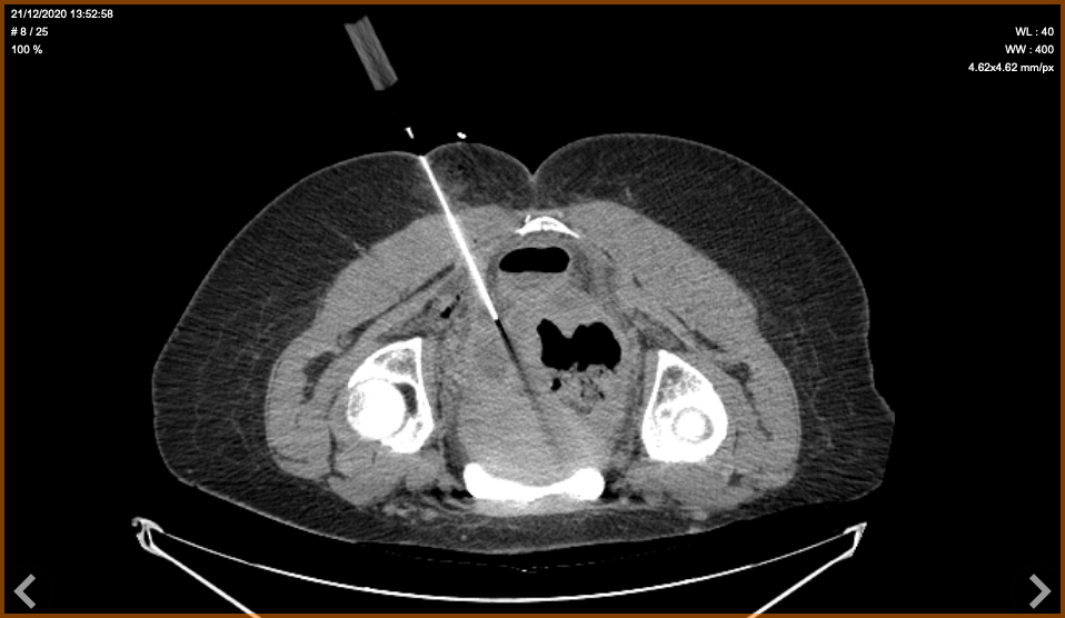 Drainage sous echographie ou sous scanner