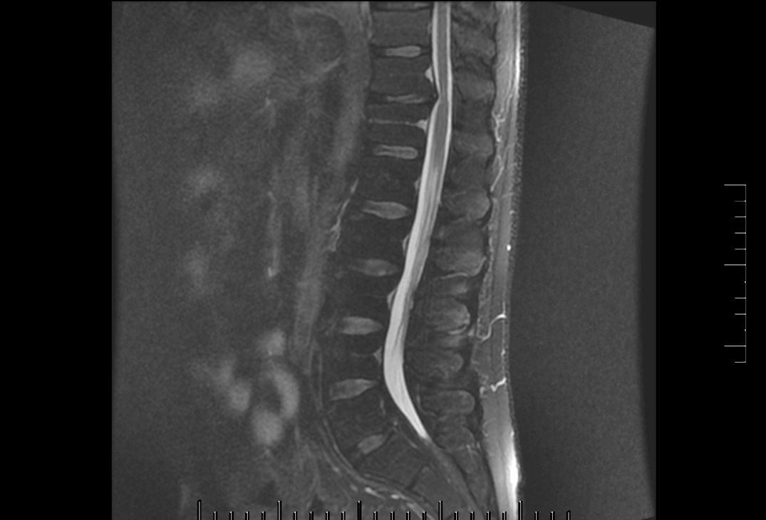 Rachis cervicale/dorsal/lambaire