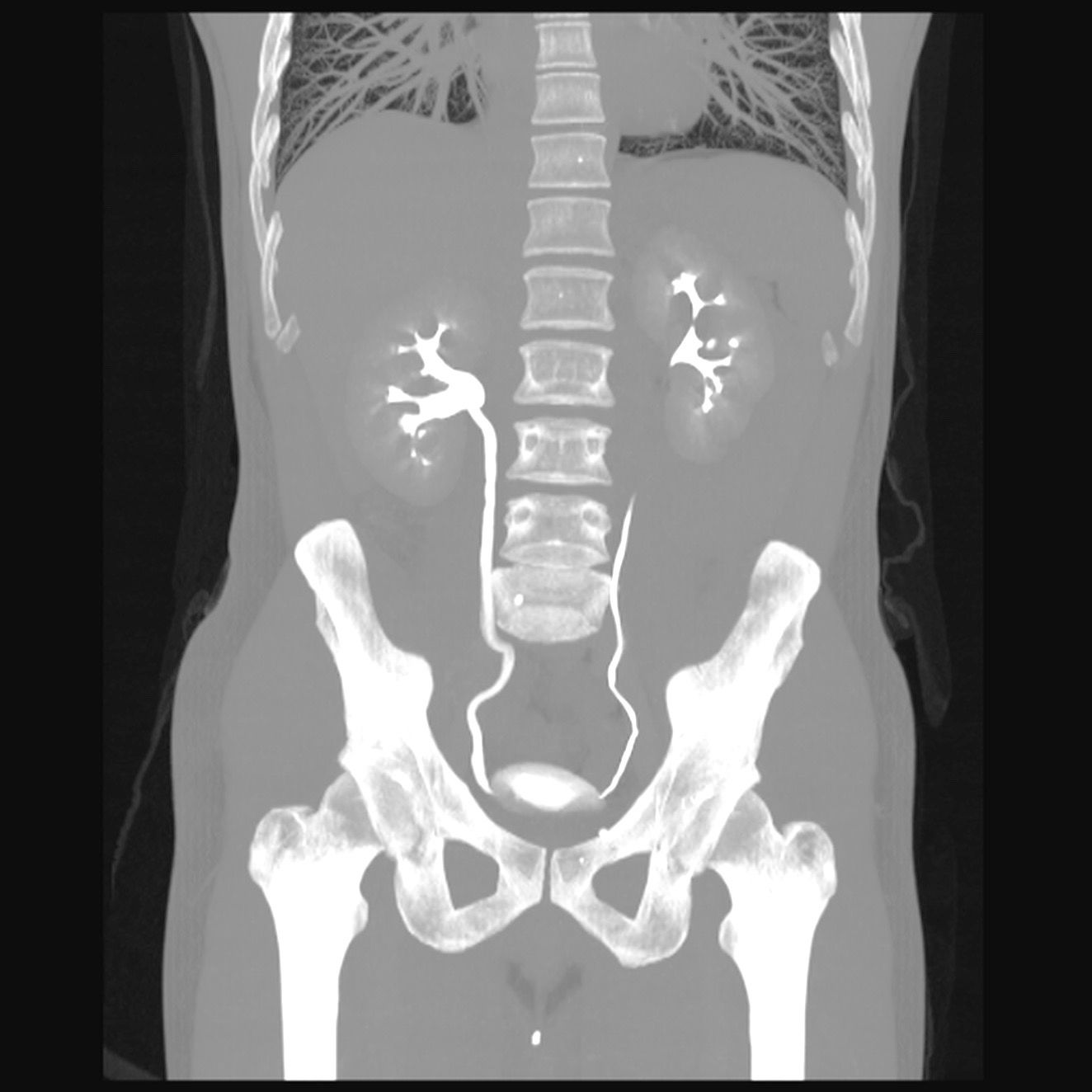 Scanner des voies urinaires (uroscanner)